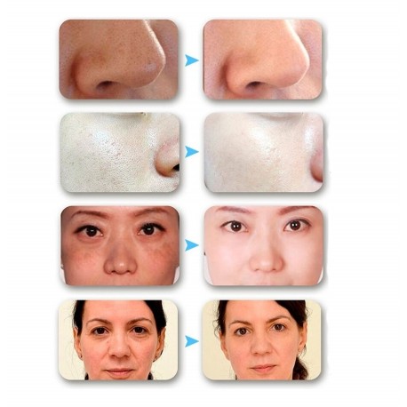 Высококачественный портативный аппарат Дарсонваль  оптом-4