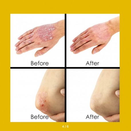 Крем-мазь Sumifun Psoriasis Cream при дерматите, псориазе 20 г оптом-4