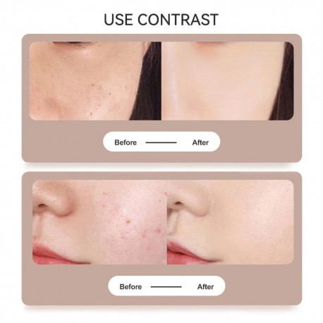 Косметический аппарат от бородавок и папиллом Point Mole Beauty Pen  оптом-3