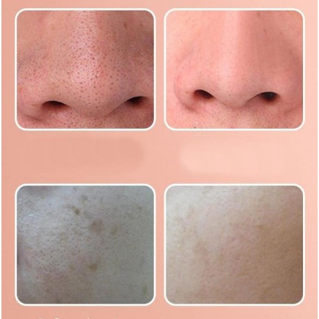 Электрический вакуумный прибор для удаление черных точек на носу  оптом-9