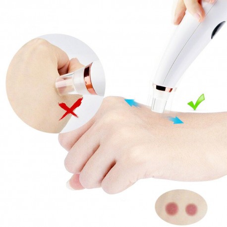 Очиститель пор для удаления угрей Point Noir Acne Aspirator  оптом-4