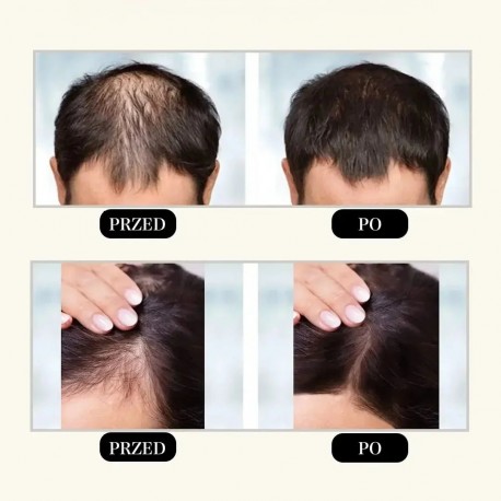 Сыворотка-спрей KORMESIC 5% Minoxidil with Biotin Scalp Serum для роста волос против выпадения 30 мл оптом-3